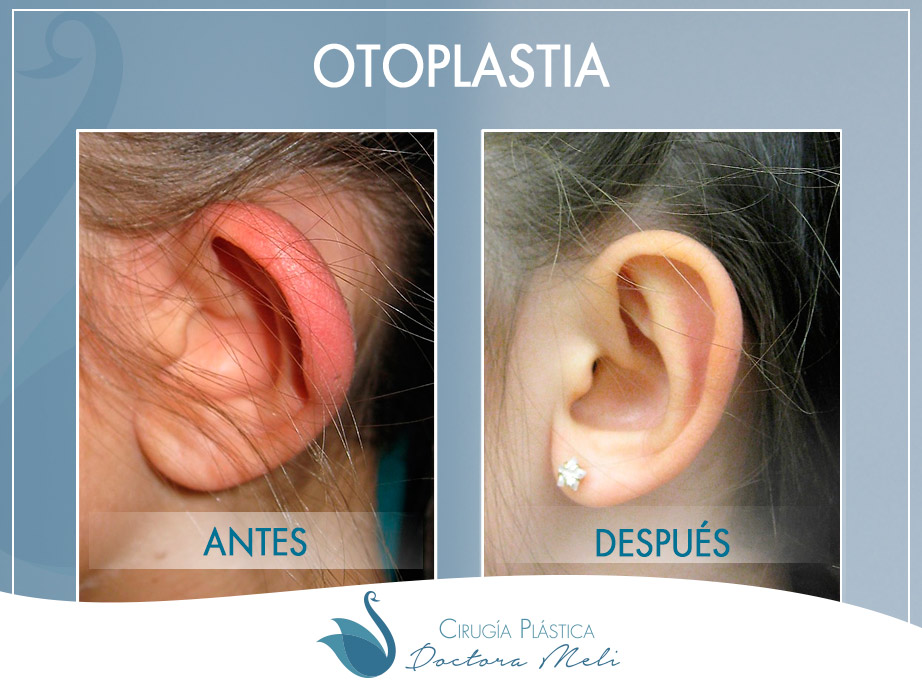 fotos antes y después otoplastia