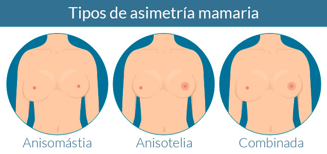 Cirugía plástica Madrid asimetría mamaria