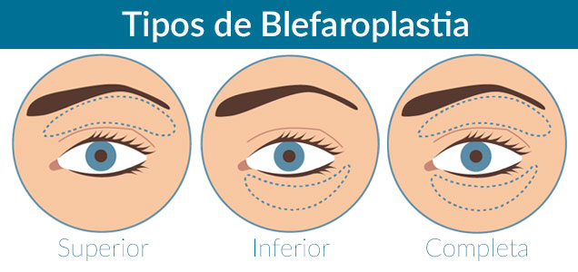 tipos de blefaroplastia