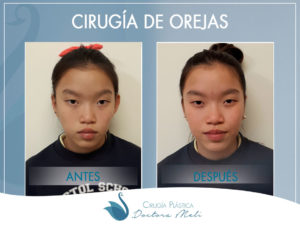 antes y después pacientes otoplastia antes y después pacientes otoplastia