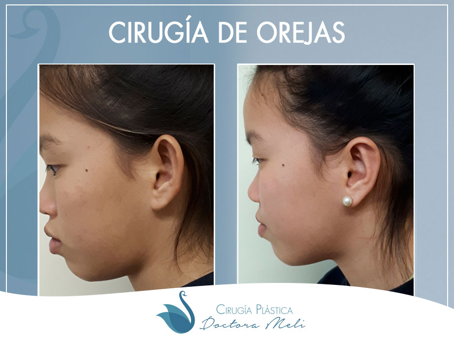resultado de otoplastia en Madrid