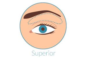blefaroplastia superior