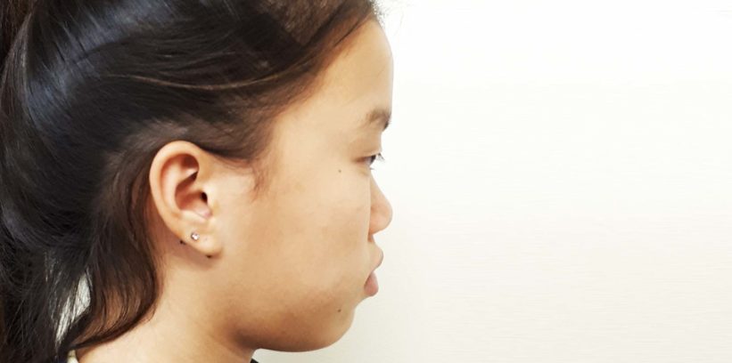 resultados de otoplastia