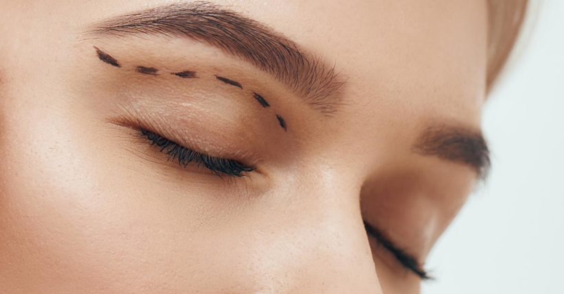 cicatrices-blefaroplastia