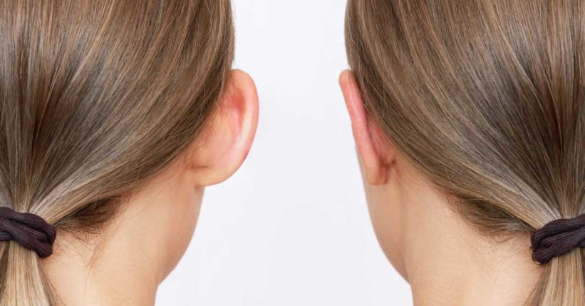 despegar orejas tras la otoplastia
