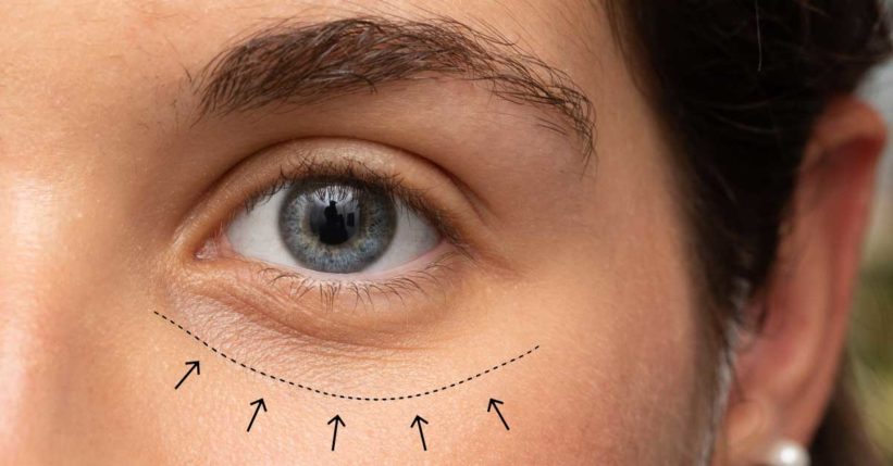 postoperatorio y recuperacion blefaroplastia