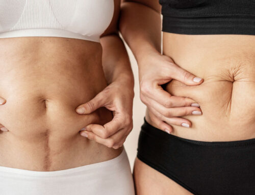 ¿La abdominoplastia es compatible tras el desarrollo de una cesárea?